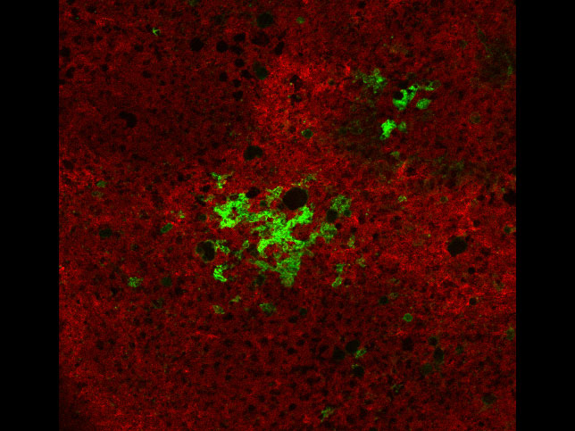 In-transit metastases in a lymph node from a spontaneously arising primary BRAFV600E PTEN-/- melanoma in mice. Red: wild-type cells; green: cancer cells 10x mag. By Lauren Adelaar, Gregory Szeto
