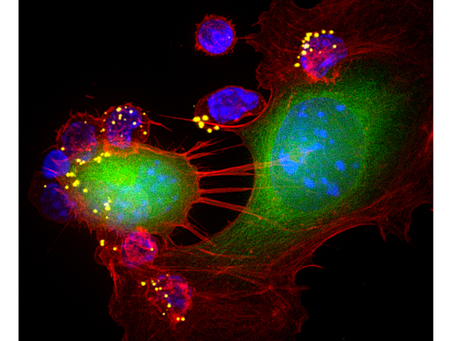 Licensed to kill. This image shows killing in action. The B16F10 tumor cell (green, CFSE) on the left attacked by multiple T cells (blue, DAPI) carrying nanopartilces (yellow, DiD) shows morphological alterations such as rounding, characteristic of poor cell health, while the tumor cell on right with T cell conjugates just being formed, is healthy. Entry is 100X. Image by Sudha Kumari/Yiran Zheng.  
